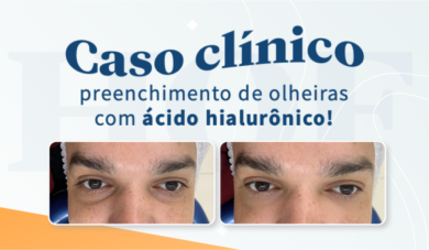 Caso clínico de preenchimento de olheiras com ácido hialurônico