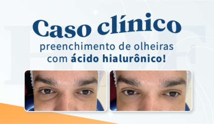 Caso clínico de preenchimento de olheiras com ácido hialurônico