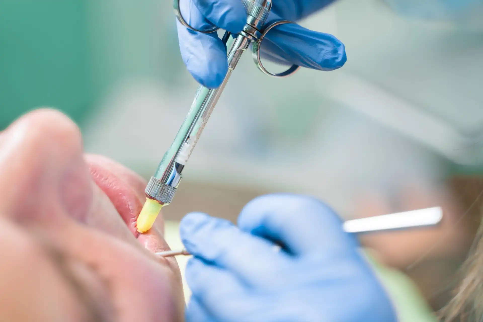 Procedimento odontológico sendo realizado com ferramentas de dental. Profissional com luvas aplica tratamento em paciente no consultório.
