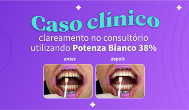 Caso clínico: clareamento em consultório com protocolo dessensibilizante