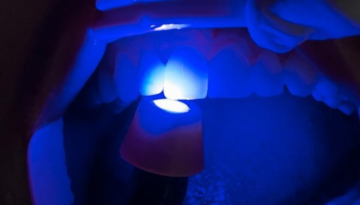 Método de transluminação para detectar possíveis trincas nos dentes do paciente.