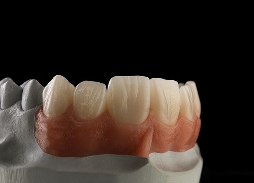 Modelo com dentes fresados em zircônia pela Fresadora Ceramill Zolid FX Multilayer. AmannGirrbach