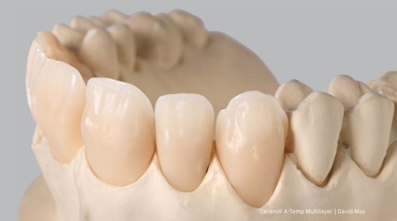 Modelo com dentes fresados com PMMA pela Fresadora Ceramill A-Temp. AmannGirrbach