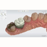Renderização digital de uma arcada dentária com coroas e pontes dentárias, mostrando detalhes do planejamento ortodôntico feito por computador para tratamentos odontológicos modernos.