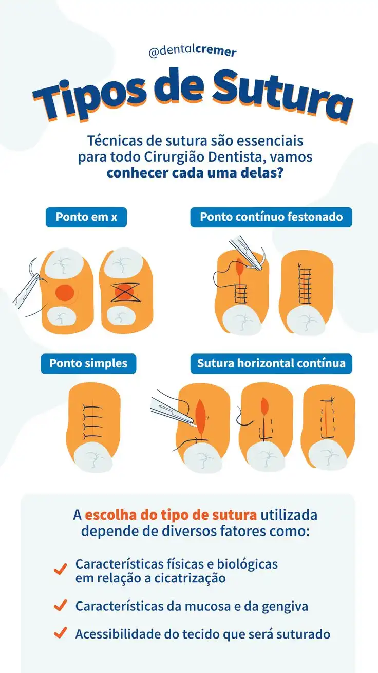 Infográfico sobre os tipos de sutura utilizados na odontologia, apresentando pontos em X, pontos contínuo festejado, pontos simples e sutura horizontal contínua, destacando a importância das técnicas de sutura para cirurgiões dentistas.
