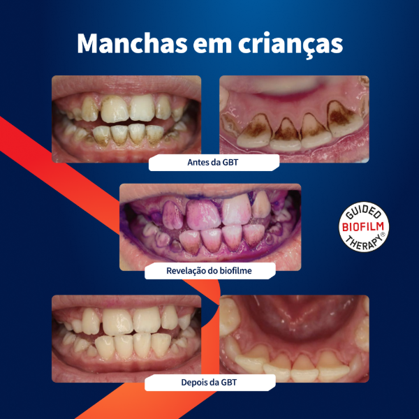 caso-clinico-airflow-ortodontia-na-adolescencia