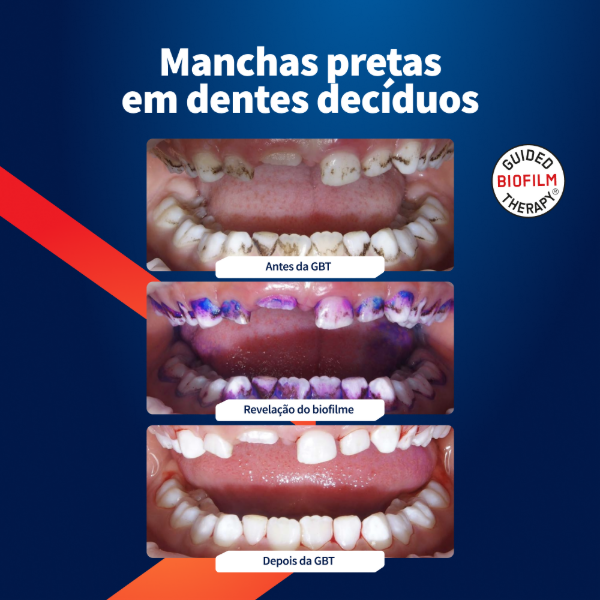 caso-clínico-airflow-manchas-odontopediatria-dentes-deciduos