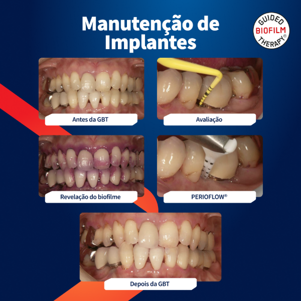caso-clinico-airflow-em-implantes
