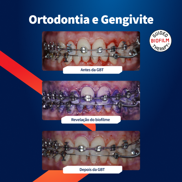 caso-clinico-airflow-ortodontia-e-gengivite