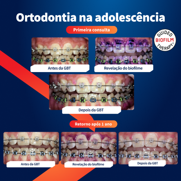 caso-clinico-airflow-ortodontia-na-adolescencia