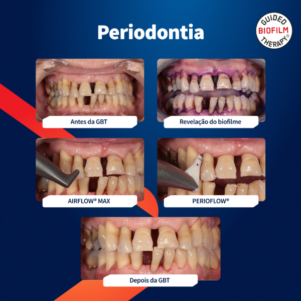 caso-clinico-periodontia-com-airflow
