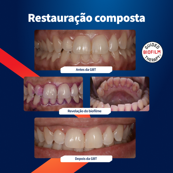 caso-clinico-airflow-restauracao-composta