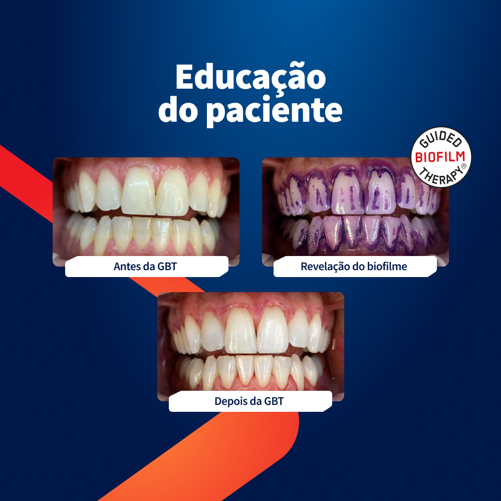 caso-clinico-com-airflow-dental-cremer