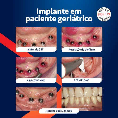 caso-clinico-profilaxia-airflow-implante