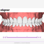 Planejameto Virtual 3D da CA-Clear Aligner evidenciando em norma frontal: