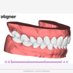 Planejameto Virtual 3D da CA-Clear Aligner evidenciando em norma lateral - Alinhadores Ortodônticos da CA Clear Aligner