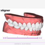 Planejameto Virtual 3D da CA-Clear Aligner evidenciando em norma lateral - Alinhadores Ortodônticos da CA Clear Aligner