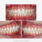 Fotos intraorais do caso clínico inicial da utilização dos Alinhadores Ortodônticos da CA Clear Aligner apresentadas em norma frontal e perfil