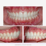 Fotos intraorais do caso clínico final da utilização dos Alinhadores Ortodônticos da CA Clear Aligner apresentadas em norma frontal e perfil