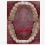 Fotos intraorais do caso clínico no inicio utilizando os Alinhadores Ortodônticos da CA Clear Aligner apresentadas em norma oclusal superior e inferior