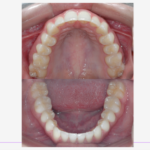 Fotos intraorais do caso clínico no final utilizando os Alinhadores Ortodônticos da CA Clear Aligner apresentadas em norma oclusal superior e inferior