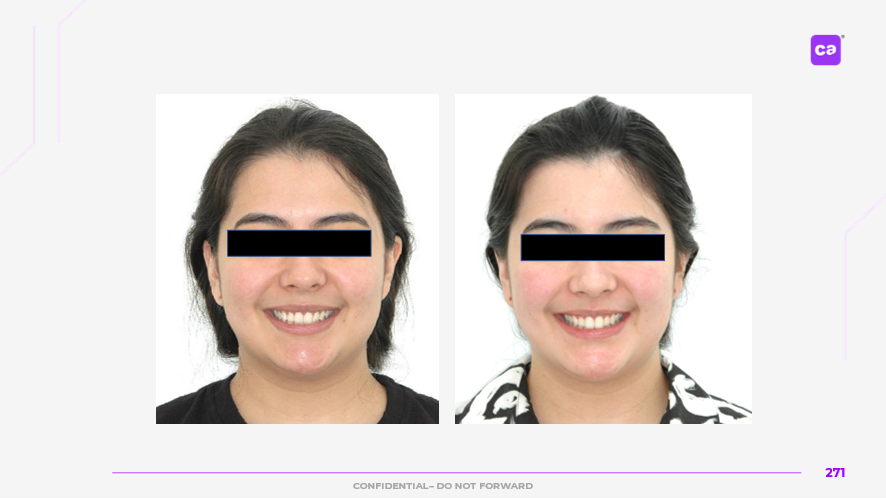 Antes e depois da paciente que utilizou os Alinhadores Ortodônticos da CA Clear Aligner
