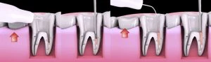 Imagem ilustrativa de dentes com tártaro, refletindo problemas de higiene bucal, tratamento odontológico e limpeza dental profissional.