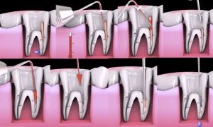 Imagem detalhada de dentes humanos, mostrando o processo de limpeza e manutenção da saúde bucal, realiando o procedimento de Fase dowpacking uma técnica de obturação dental