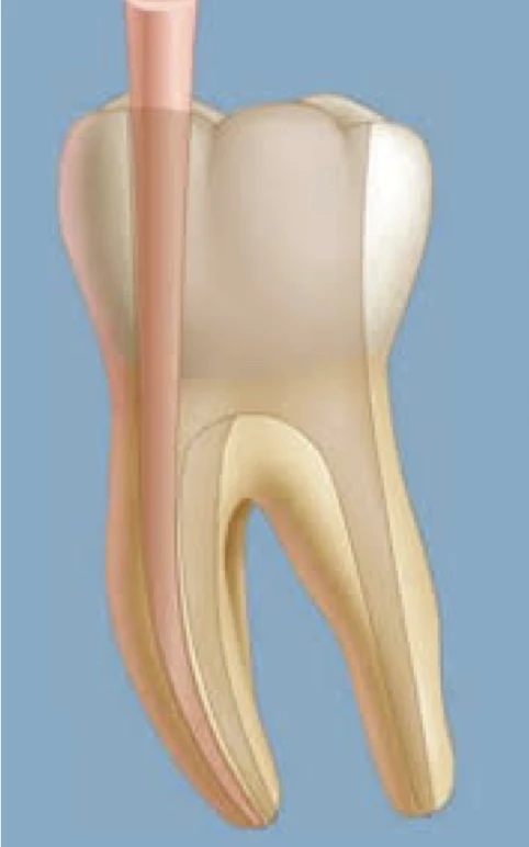 Imagem anatômica de um dente com foco na estrutura da Polpa Dental e nervos, destacando a importância da saúde bucal e prevenção de doenças dentárias.
