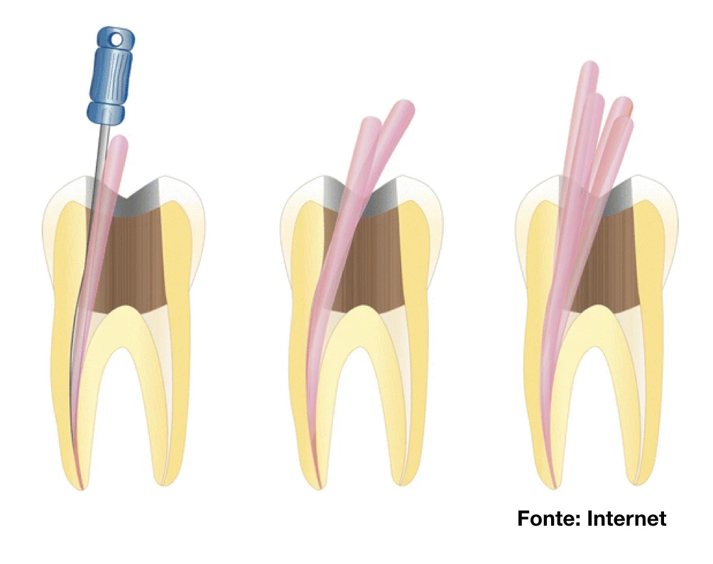 Ilustração do procedimento de tratamento de canal, mostrando o uso de instrumentos específicos para remover a polpa danificada e limpar o interior do dente, seguido por preencher o espaço com material de obturação.