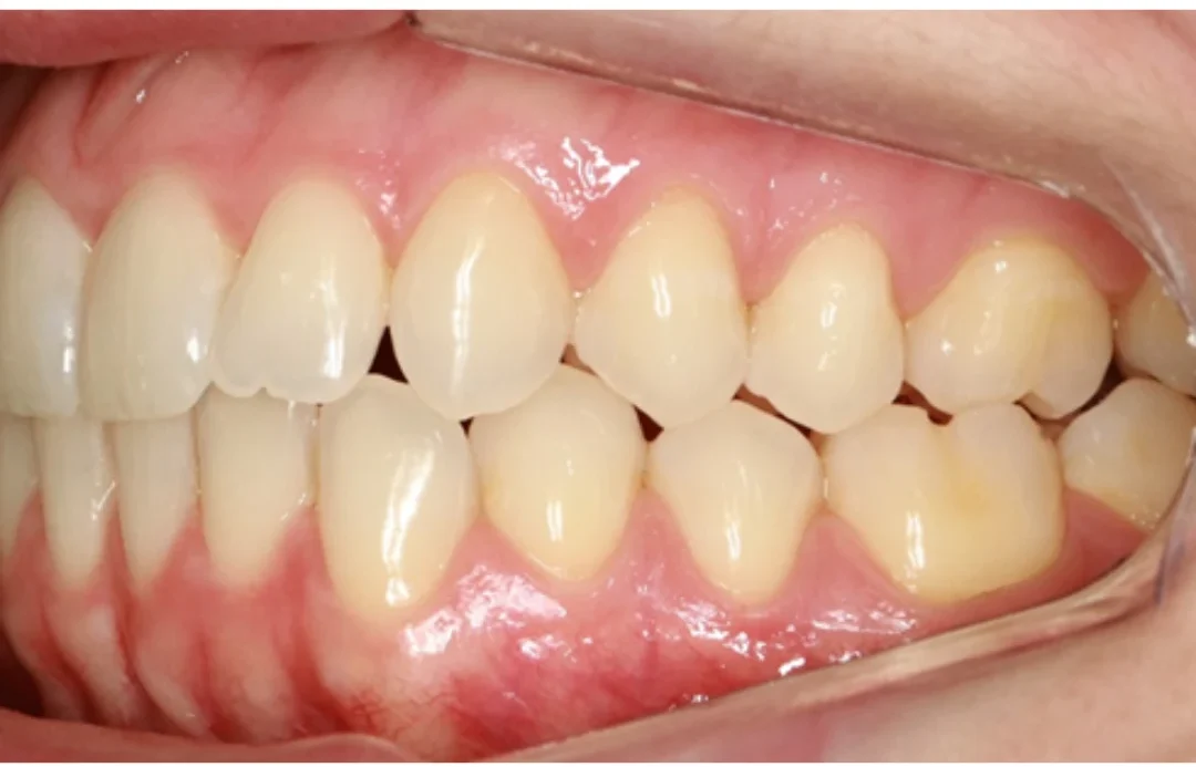 Imagem de dentes com leve descoloração e gengivas saudáveis, ideal para discutir cuidados dentários e estética bucal.