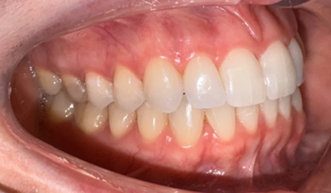 Imagem mostrando a arcada dentária de um paciente, destacando a saúde bucal e dentes alinhados. Ideal para referencia em cuidados odontológicos.