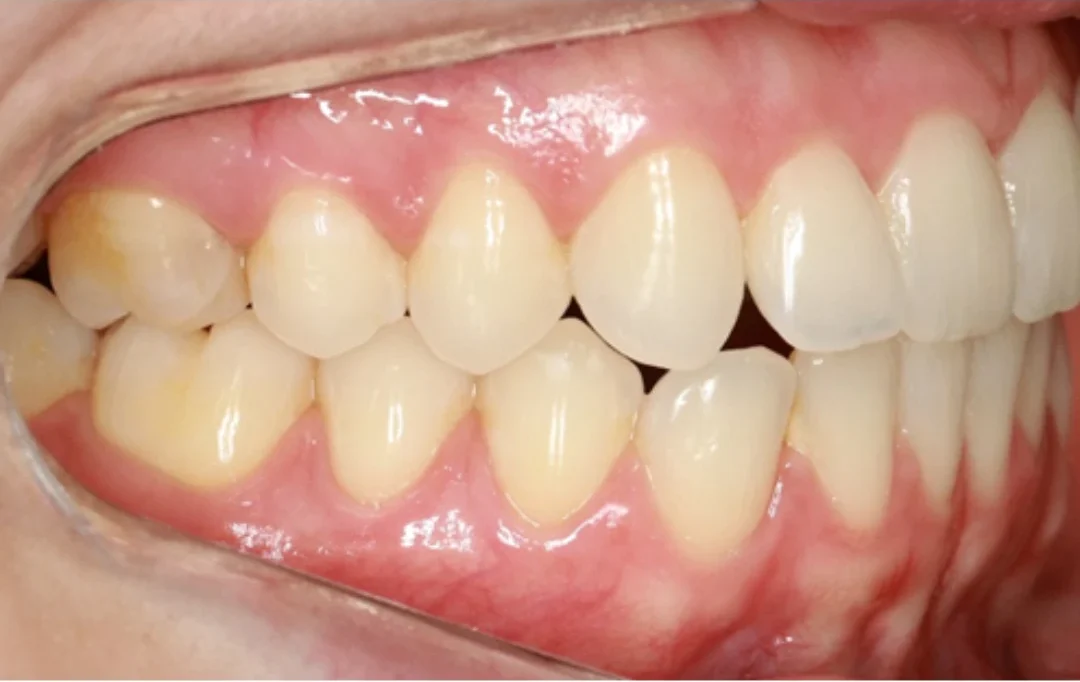 Imagem mostrando dentes e gengivas com foco na saúde bucal. Importância de cuidados dentários para um sorriso saudável e bonito.