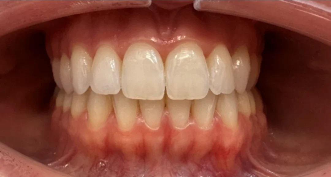 Imagem detalhada de um sorriso com dentes brancos e saudáveis, mostrando gengivas em boa condição. Ideal para artigos sobre saúde bucal e cuidados odontológicos.
