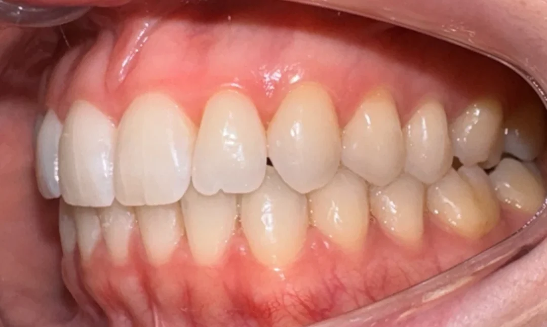 Imagem de um sorriso com dentes brancos e saudáveis, destacando a importância da higiene bucal para um sorriso perfeito.
