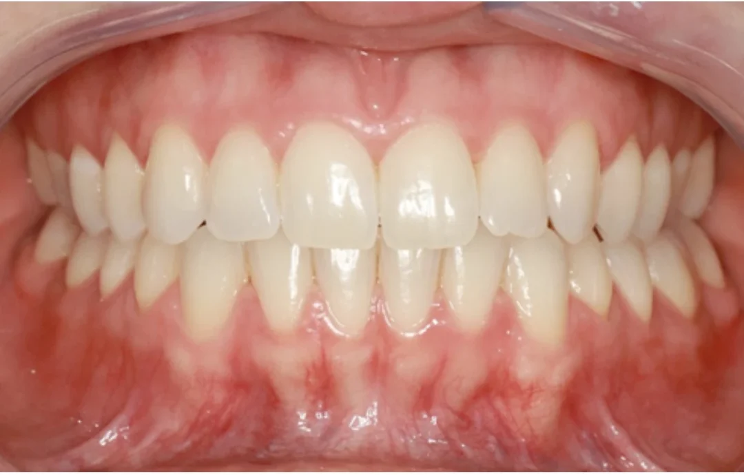Imagem detalhada dos dentes saudáveis com foco em um sorriso branco e bonito, destacando a saúde bucal e a estética dental.