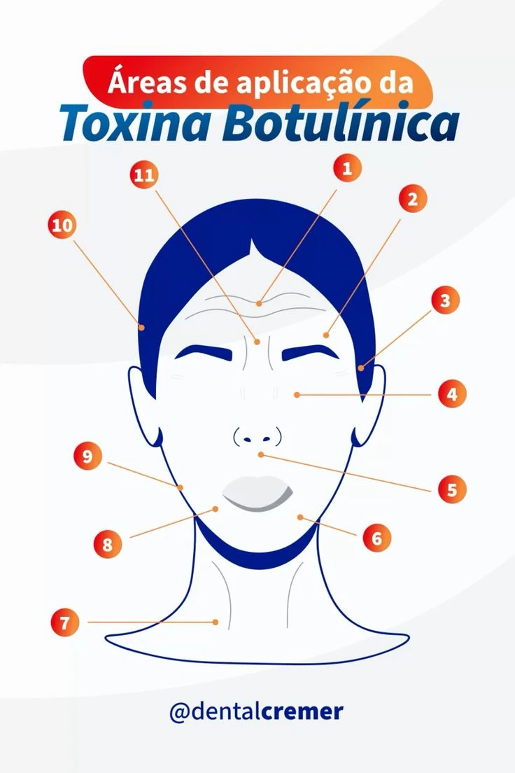 Infográfico sobre as áreas de aplicação da toxina botulínica no rosto, destacando regiões como testa, sobrancelhas, olhos, boca, queixo e pescoço, para tratamentos estéticos.