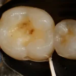 Imagem de uma cárie dental em um molar, evidenciando a deterioração do esmalte e a presença de cavidade, explicando a importância da higiene bucal.