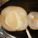 Dente tratado com técnica de odontologia restauradora, com material de obturação visível na cavidade, mostrando detalhes do procedimento de restauração dental.