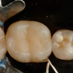 Imagem de dentes brancos sendo tratados, envolvendo procedimentos odontológicos com foco na higiene bucal e saúde dental.