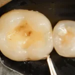 Imagem de dentes com cárie, mostrando a cavidade dentária e áreas afetadas por deterioração. Importância de higiene bucal para evitar problemas dentários.