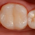 Imagem de dentes molares superiores com esmalte saudável e sem cáries, visão próxima mostrando detalhes da superfície dentária.