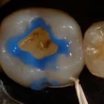 Imagem de dentes durante procedimento odontológico com aplicação de material condicionador ácido, mostrando cavidade e preparo para obturação.