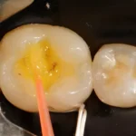 Imagem mostrando o procedimento de obturação de um dente com uso de material odontológico tópico, iluminando a cavidade para restaurar a saúde dental.