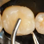 Imagem mostrando um procedimento odontológico em dentes, com instrumentos especializados, destacando a importância do cuidado e tratamento dental.