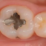 Imagem de uma dentição com restauração antiga e cárie ainda presente no dente, evidenciando a necessidade de cuidados odontológicos.