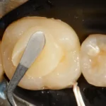 Tratamento de canal dentário sendo realizado com instrumento em dente, procedimento odontológico para remover infecção na raiz.