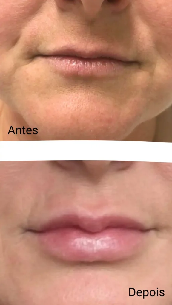 Antes e depois de um procedimento de rejuvenescimento labial mostrando lábios com aspecto envelhecido na imagem superior e lábios mais jovens e finos na imagem inferior, destacando a melhora na aparência dos lábios.
