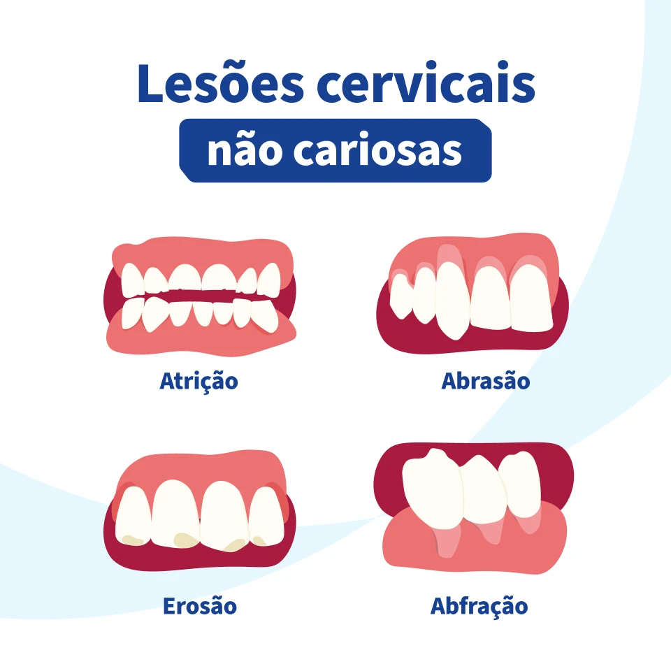 Ilustrações de diferentes tipos de lesões cervicais não cariosas, incluindo atração, abrasão, erosão e abfração, relacionadas à saúde bucal.