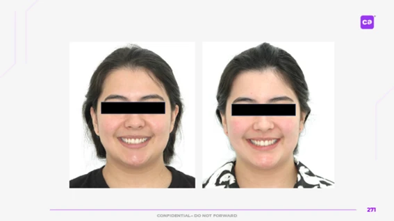 Duas fotos de uma mulher sorrindo, mostrando melhorias na pele e na estética facial após tratamento, com aparência mais jovial e revitalizada.